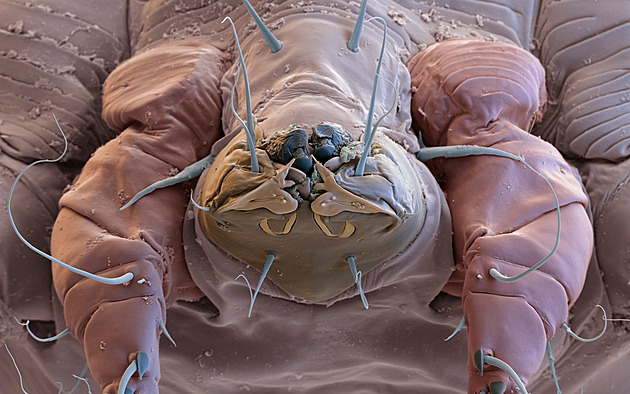 Na Ostravsku a Bruntálsku ve velkém řádí svrab. Kraj má nepěkné prvenství