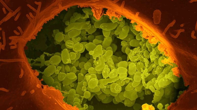 Extrémně vzácná nemoc se objevila na Slovensku. Podívejte se, jaké jsou příznaky Q horečky