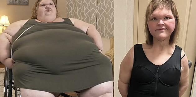 Morbidně obézní ženě dávali lékaři rok života. Radikálně zhubla a je šťastná
