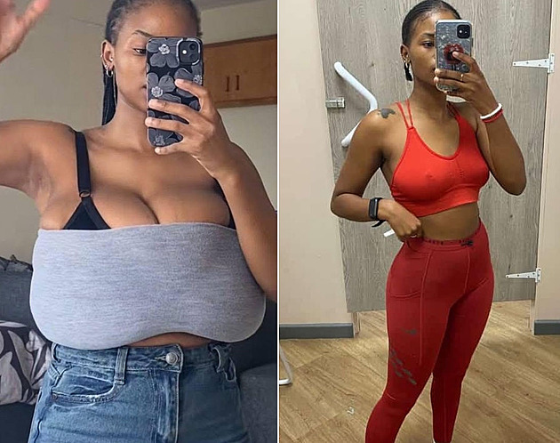 Gigantomastie je prokletí, říká žena, které prsa vyrostla o pět velikostí