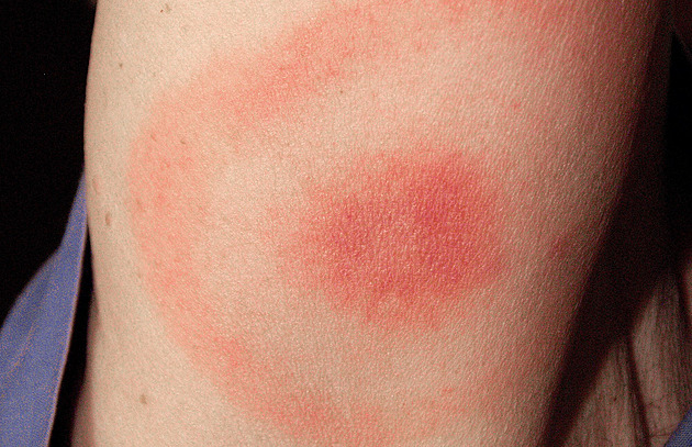 Nemocí z klíšťat je letos nejvíc za poslední dekádu