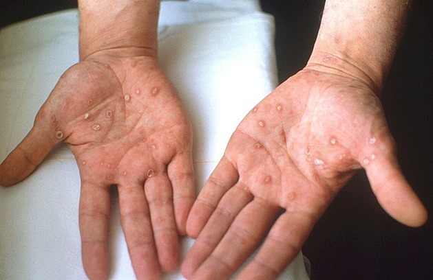Slovensko loni zaznamenalo rekordní počet případů syfilidy, většinu tvoří muži