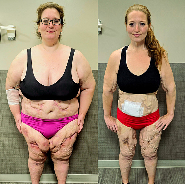 Zhubla sto čtyřicet kilogramů, přesto žena nemůže do bazénu