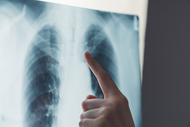 Bolesti zad mu změnily život. Lékaři odhalili rakovinu plic